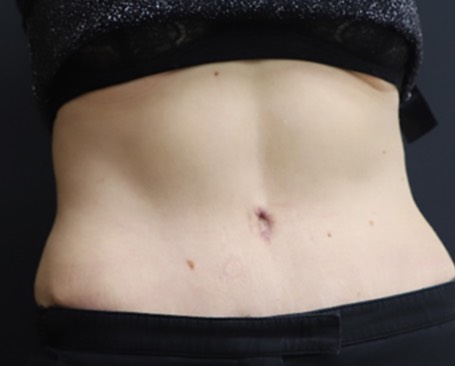 After Abdominoplasty Dubai