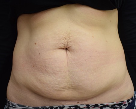 Before Abdominoplasty Dubai