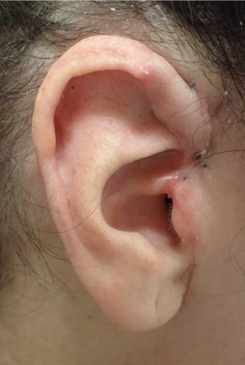 Ear Reconstruction - After