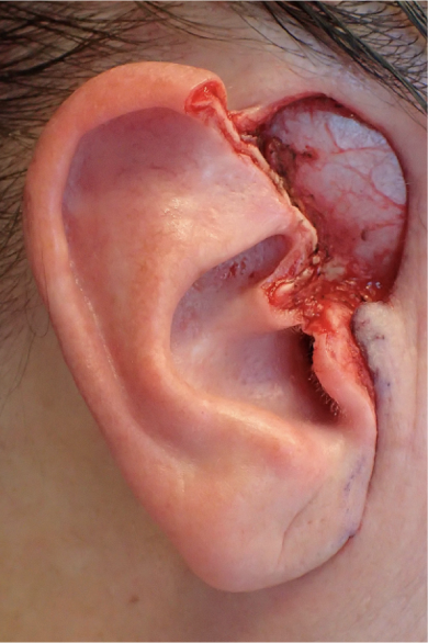 Ear Reconstruction Before - local flap