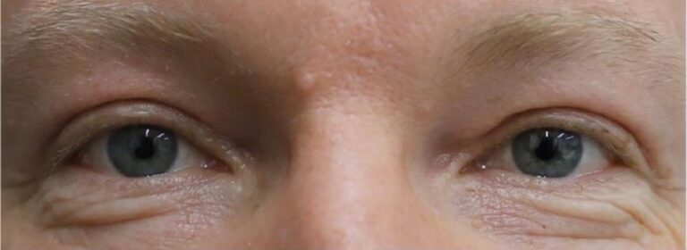 Blepharoplasty Dubai - Male - Before and After - Dr Parviz