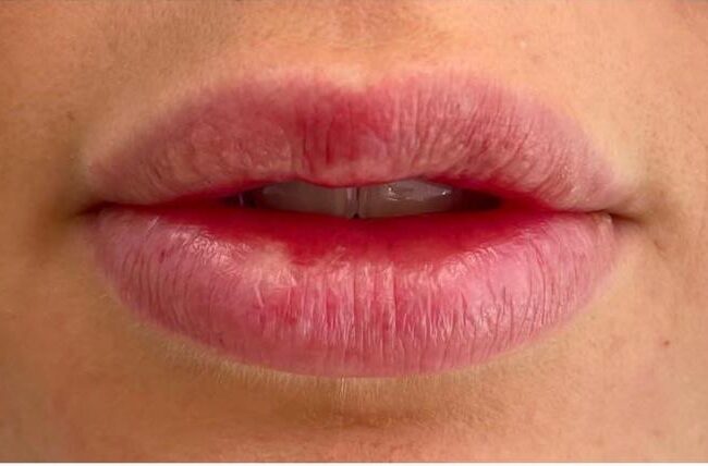 Lip Fillers Before and After Pictures Dr Parviz