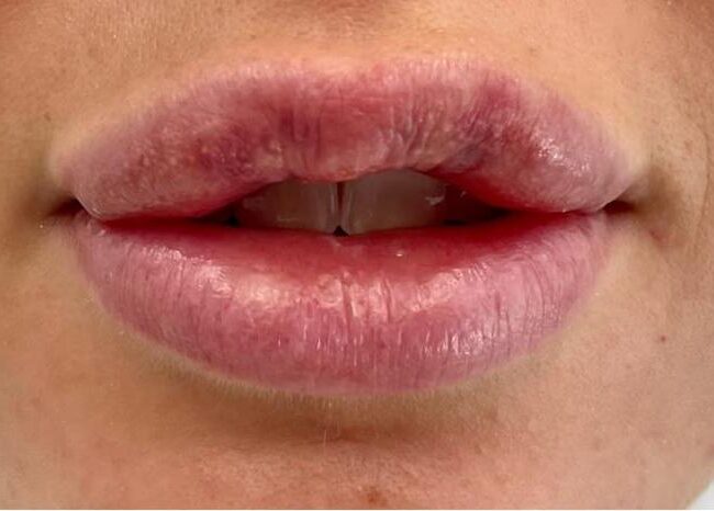 Lip Fillers Before and After Pictures Dubai