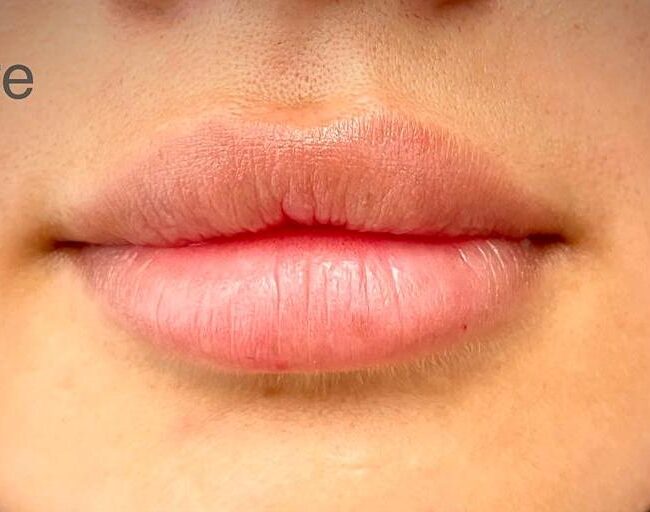 Lip Fillers Dubai - Before - Dr Parviz Sadigh