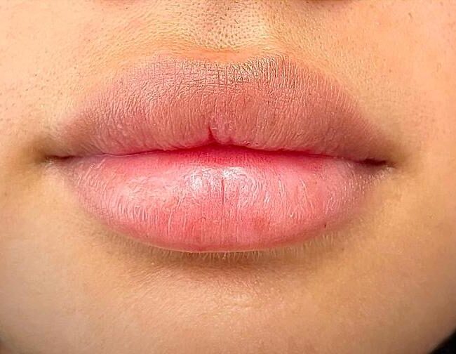 Lip Fillers Dubai - Before and After - Dr Parviz Sadigh