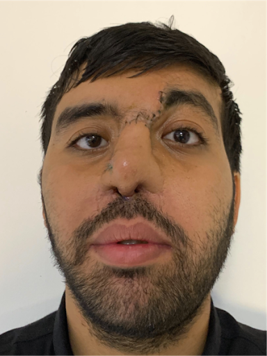 Nose Reconstruction After - Dr Parviz Sadigh