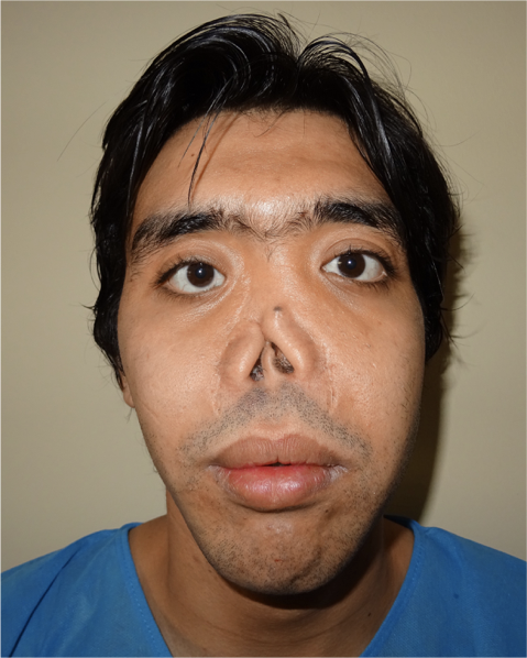 Nose Reconstruction Before - Dr Parviz Sadigh