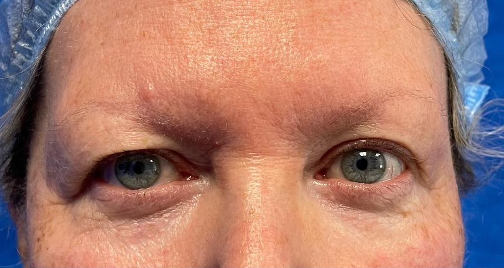 Upper Eyelid blepharoplasty - Before and After