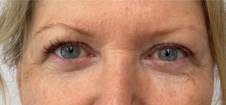 Upper Eyelid blepharoplasty - After - Dr Parviz Sadigh