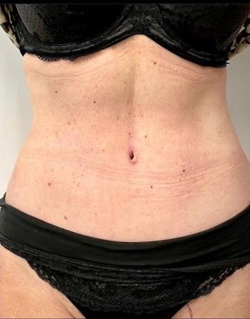 Tummy Tuck Before and After - Dr Parviz Sadigh