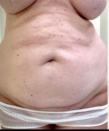 Tummy Tuck Before and After Dubai - Dr Parviz Sadigh