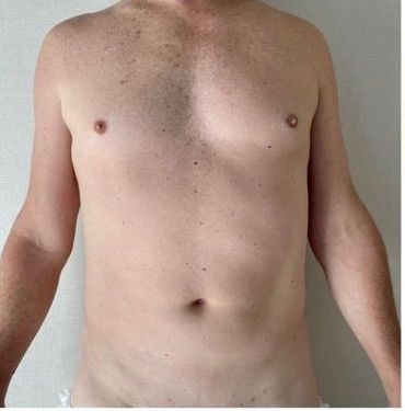 Male Tummy Tuck Before and After Dubai