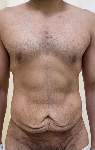 Tummy Tuck Dubai Man Before and After