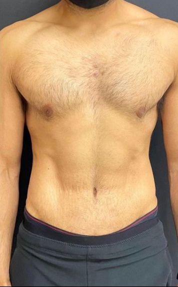 Tummy Tuck Dubai After - Dr Parviz Sadigh