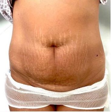 Female Tummy Tuck Before and After Dubai - Dr Parviz Sadigh