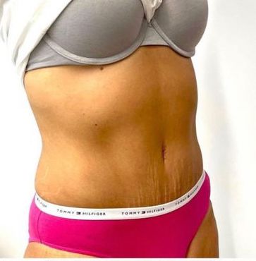 Female Tummy Tuck Before and After Dubai, UAE